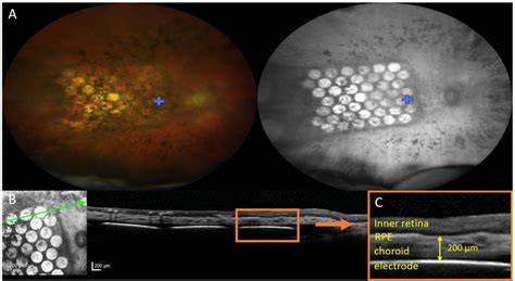 A Fundus Images Of The Electrode Array At 12 Weeks After Surgery For