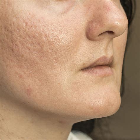 Reduce Acne Scars Nima Skin Institute