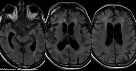 Dr Balaji Anvekar Frcr Hiv Encephalitis Vs Pml
