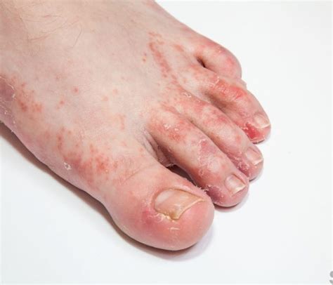 What Causes A Rash On My Feet