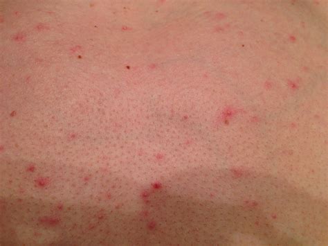 Candida Rashes Is Your Yeast Rash Caused By Yeast Imbalance On Skin Kulturaupice