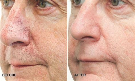 Ipl Bbl Photofacial Rejuvenate Renew And Restore The Skin