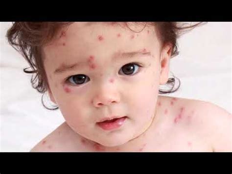 Gangguan kulit ini kerap membuat bayi merasa gatal. Bintik Merah pada Kulit Bayi yang Umum Terjadi - YouTube