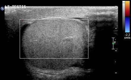 Testicular Torsion Radiology Reference Article Radiopaedia Org