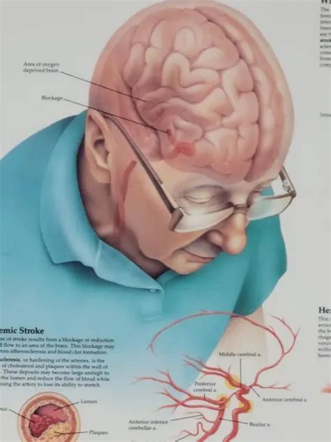 Vintage Laminated Medical Poster Understanding Stroke Anatomical Chart
