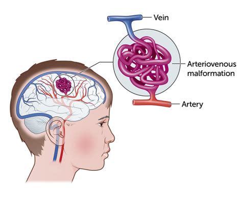 Kids Health Information Cerebral Arteriovenous Malformation Avm