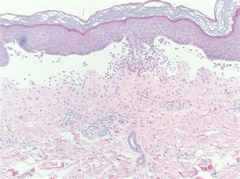 Bullous Pemphigoid Textbook View Image Dermatology