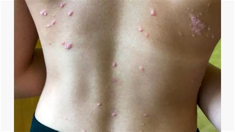 Guttate Psoriasis Pictures Causes Treatment And More