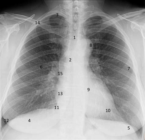 Fund Of Imaging Exam Cxr Label Flashcards Quizlet