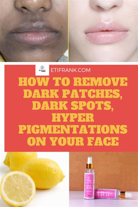 Pin By Skincare Beauty Hacks Health On Home Remedies All In 2020