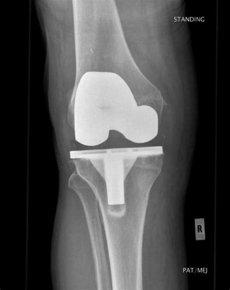 Radiograph Post Medial Femoral Osteophyte Excision Arrow Tibial And