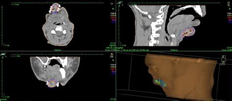 Head And Neck Cancer Ct Image Based Treatment Plan Tumor Recurrence