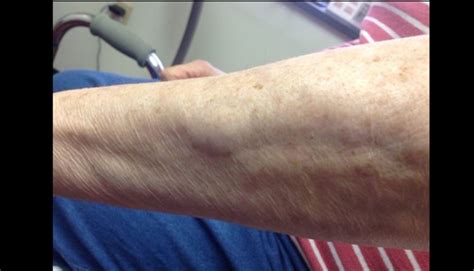 Clinical Challenge A Nodule On The Forearm Mpr