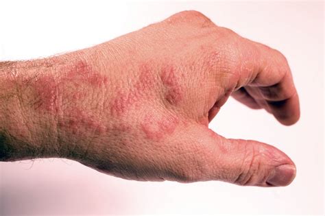 Dermatite Allergia Pelo Gatto Dermatite Allergica Gatti Trattarla Hot Sex Picture