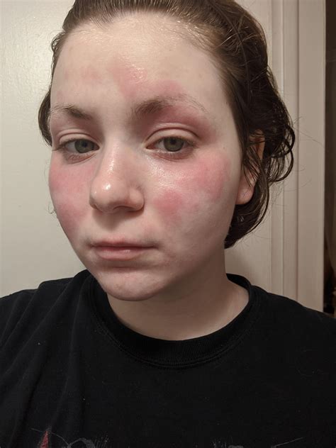 Red Skin Rash On Face