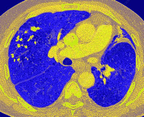 Tuberculosis Of The Lung Ct Scan Stock Image C0261126 Science