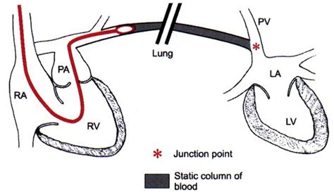 Pulmonary Capillary Wedge Pressure Swan Ganz Catheter Nursing Tips