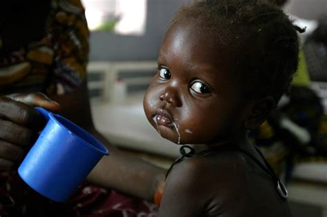 A Severely Malnourished Baby Girl Is Fed Therapeutic Milk In A Unicef
