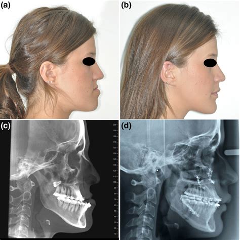 Versatile Facial Osteotomies Lim 2018 Australian Dental Journal