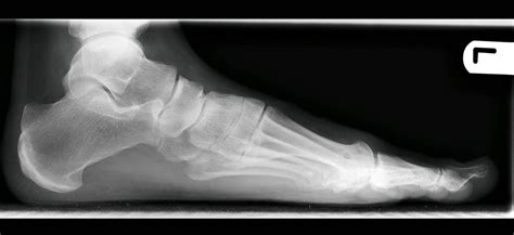Left Foot Pre Op Pre Op X Ray Left Foot Lateral Now That Flickr