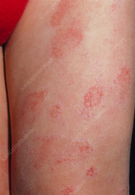 Eczema On The Leg Of A Child Stock Image M1500090 Science Photo