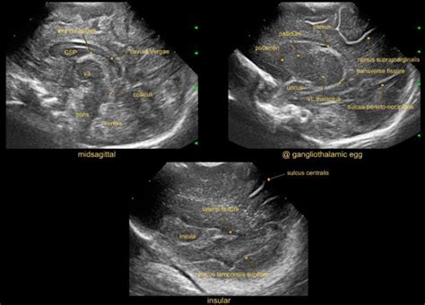 State Of The Art Cranial Ultrasound Imaging In Neonates Protocol