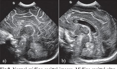 Abnormal Neonatal Head Ultrasound