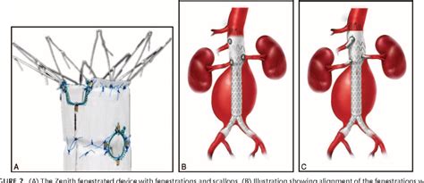 Pdf Experience With Fenestrated Endovascular Repair Of Juxtarenal