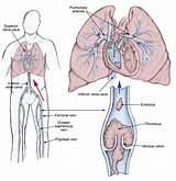 Pictures of Medical Treatment For Pulmonary Embolism