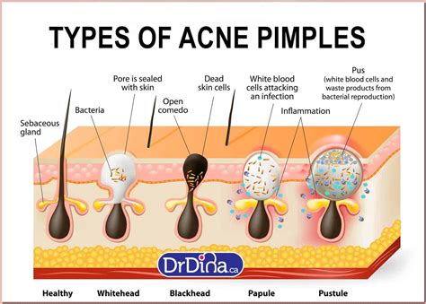 Baby Acne Different Types Of Acne And How To Prevent It