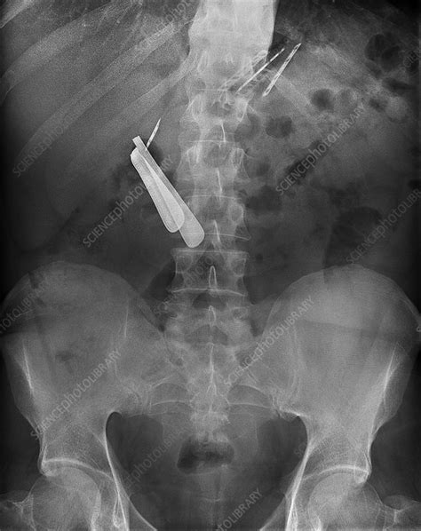 Swallowed Razor And Razor Blades X Ray Stock Image M3150036 Science Photo Library
