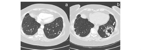 Sclc Axial Contrast Enhanced Chest Ct Scan Lung Window Performed In