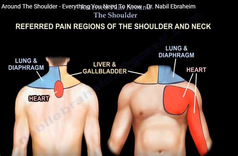 Referred Pain Around The Shoulder —