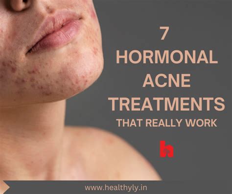 7 Tried And Tested Hormonal Acne Treatments That Really Work