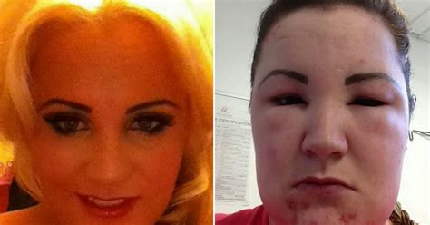 Woman S Face Swells To Three Times Normal Size After Allergic Reaction To Hair Dye Mirror Online