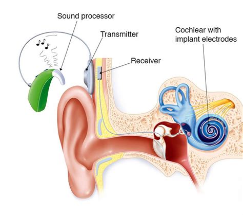 Cochlear Implant Restoring Hearing Ear And Hearing Australia