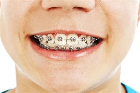 How Do I Know If I Need Braces True Orthodontics Pc