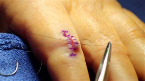 Index Finger Cyst Removal Breakdown Youtube