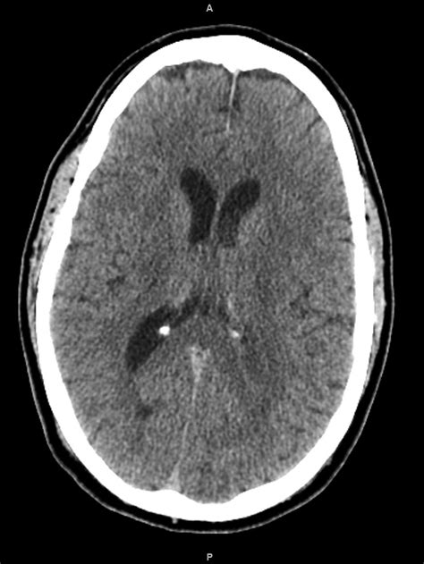 Brain Ct Demonstrating Severe Obstructive Hydrocephalus Secondary To