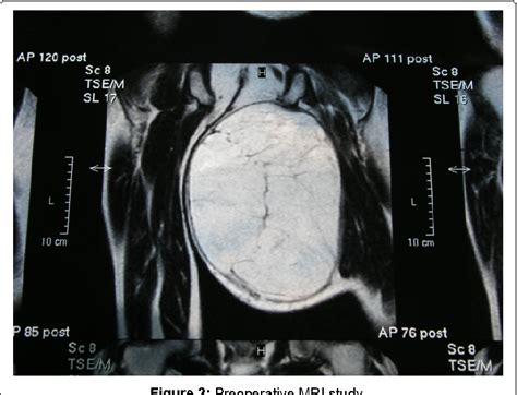 Figure 2 From Giant Mixed Lipomaliposarcoma Of The Thigh Diagnostic