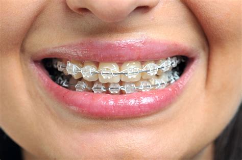 Officially, the jury is out on whether an oral irrigator is. Orthodontists in Andover & Lawrence, MA | Metal & Clear Braces