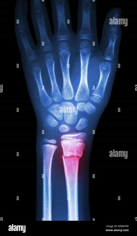 Fiilm X Ray Wrist Show Fracture Distal Radius Forearms Bone Stock