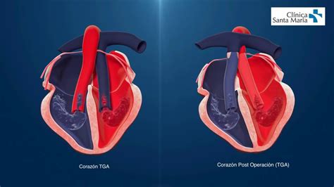 Ectopia Cardiaca Estenosis Valvular Aortica Y Transposicion De Los