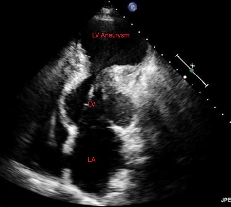 Late Presentation Of Hypertrophic Cardiomyopathy With Apical Aneurysm