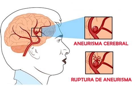 O Que Aneurisma Cerebral Sintomas Sequelas Cirurgia Tem Cura