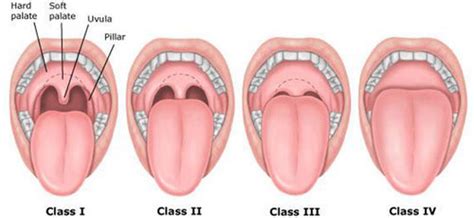 Swollen Uvula Causes Pictures Remedies And Treatment