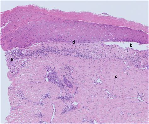 Bullous Pemphigoid In A Lichen Sclerosus Lesion American Journal Of