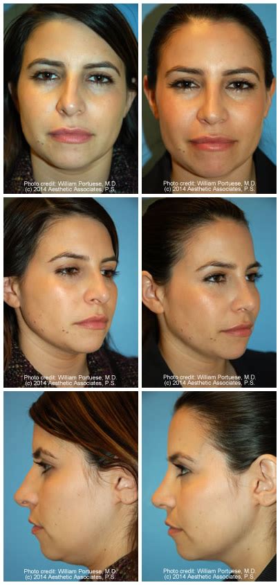Crooked Nasal Bones Before And After Photo Gallery Nose