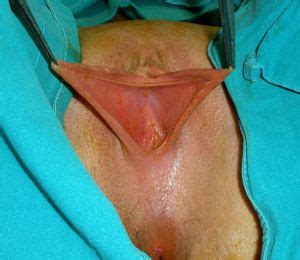 Labioplasty Labia Minora Reconstruction