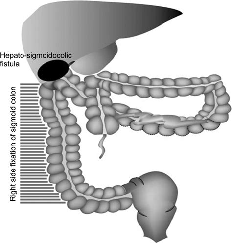 Schematic Drawing Of The Operation Finding Sigmoid Colon And Upper